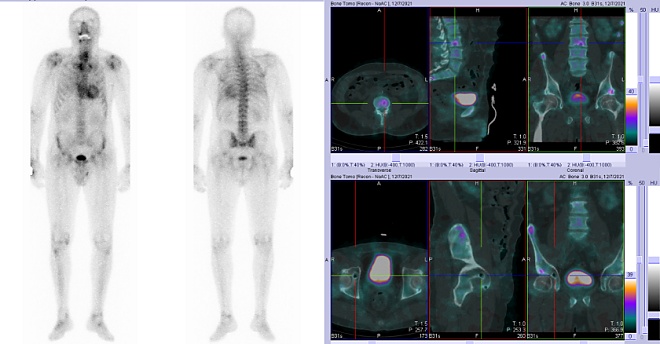 Obr. č. 1: Celotělová scintigrafdie skeletu a SPECT/CT.