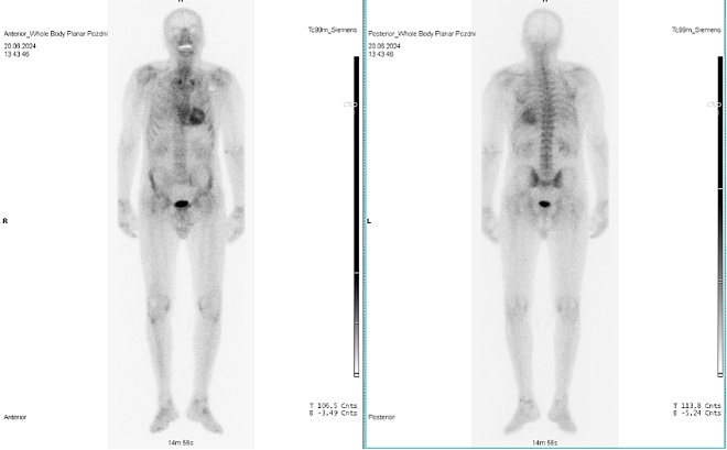 Obr. �. 2: Celot�lov� scintigrafie skeletu.