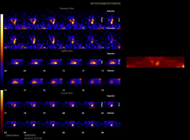Obr.3.: Scintigrafie příštítných tělísek pomocí 99mTc-MIBI metodou SPECT se zřetelnou patologickou ložiskovou depozicí radiofarmaka dorzálně od dolního pólu pravého laloku štítnice.