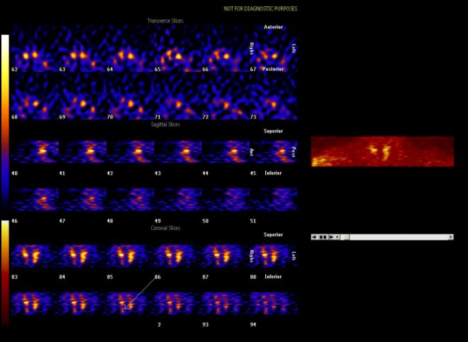 Obr.3.: Scintigrafie příštítných tělísek pomocí 99mTc-MIBI metodou SPECT se zřetelnou patologickou ložiskovou depozicí radiofarmaka distálně od dolního pólu pravého laloku štítnice.