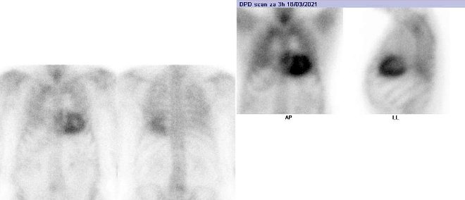 Obr.č.2: „Celotělová“ scintigrafie v přední a zadní projekci vdélce 70 cm a statická scintigrafie hrudníku v přední a levé boční projekci. Vyšetření 3 hodiny po aplikaci radiofarmaka.
