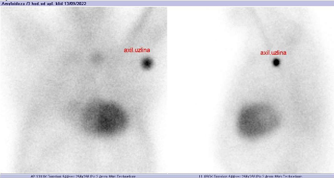 Obr..1: Statick scintigrafie hrudnku v pedn a lev bon projekci. Vyeten 3 hodiny po aplikaci radiofarmaka. Zobrazena axilrn uzlina pi sten paravenozn aplikaci radiofarmaka.