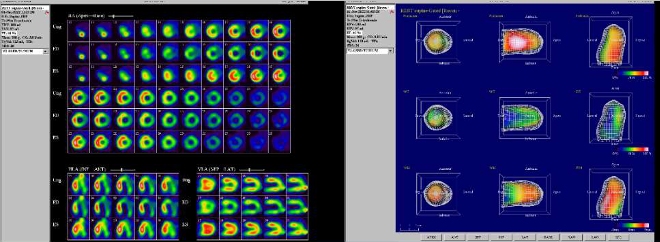 Obr..2: Gatovan tomografick scintigrafie myokardu.