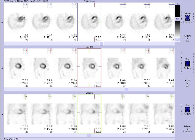 Obr. . 2: Gatovan tomografick scintigrafie myokardu.