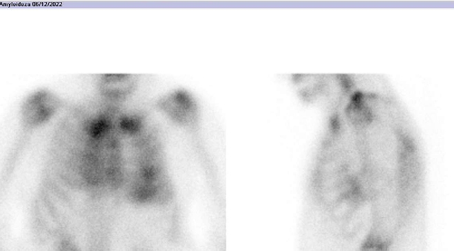 Obr.1: Statick scintigrafie hrudnku v pedn a lev bon projekci. Vyeten 3 hodiny po aplikaci radiofarmaka.