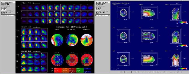 Obr.2: Gatovan tomografick scintigrafie myokardu na kamee Symbia T2 Siemens s LEHR kolimtory.