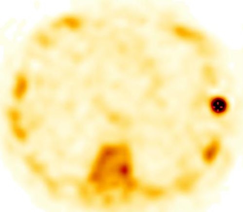 Obr. 3: SPECT, transverzln ez.