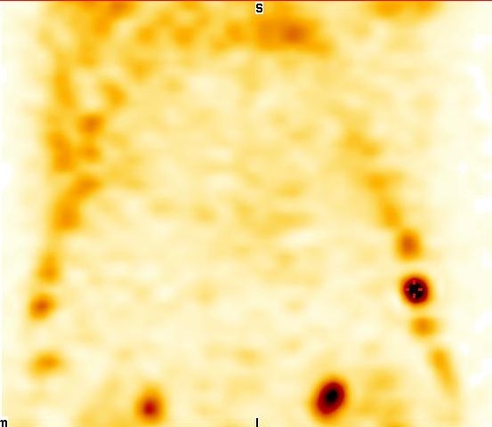 Obr. 4: SPECT, koronrn ez.