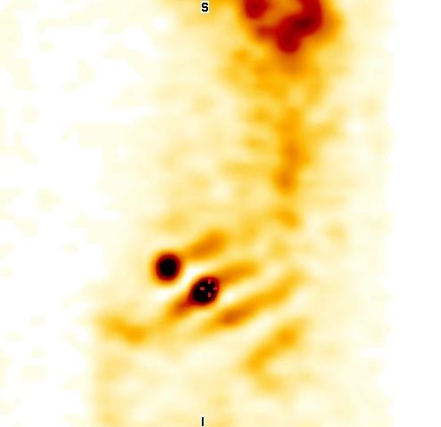 Obr. 5: SPECT, sagitln ez.