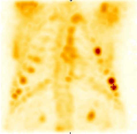 Obr. 6: SPECT, 3D rekonstrukce.