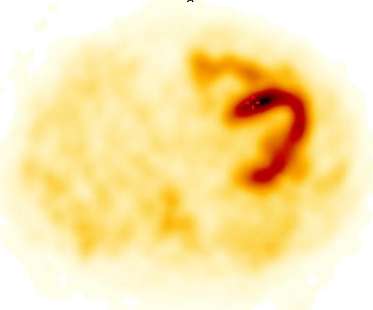 Obr. 3: SPECT, transverzln ez.