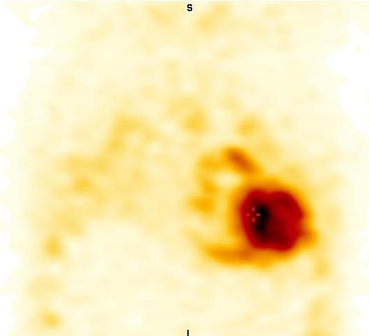 Obr. 4: SPECT, koronrn ez.
