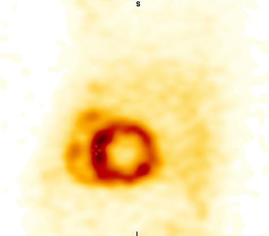 Obr. 5: SPECT, sagitln ez.