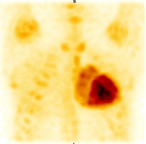 Obr. 6: SPECT, 3D rekonstrukce.