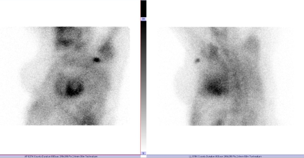 Obr.1: Statická scintigrafie hrudníku v přední a levé boční projekci. Vyšetření 3 hodiny po aplikaci radiofarmaka.
