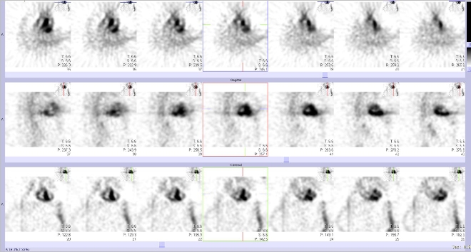Obr..2: Tomografick scintigrafie myokardu.