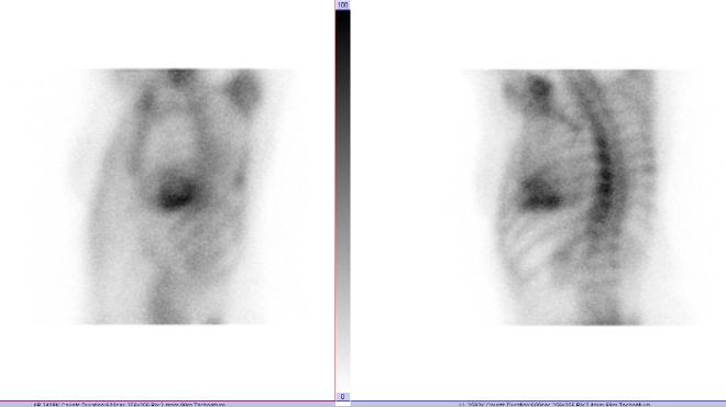 Obr.1: Statick scintigrafie hrudnku v pedn a lev bon projekci. Vyeten 3 hodiny po aplikaci radiofarmaka.