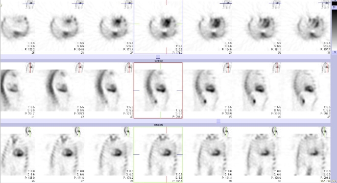 Obr..2: Tomografick scintigrafie myokardu.