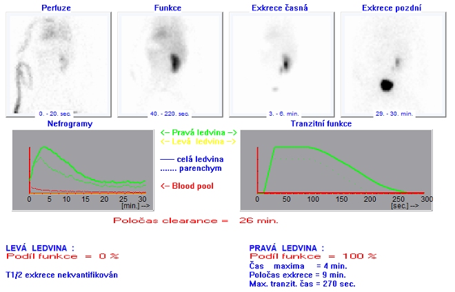 Obr. . 2: Dynamick scintigrafie ledvin v zadn projekci v poloze vlee.