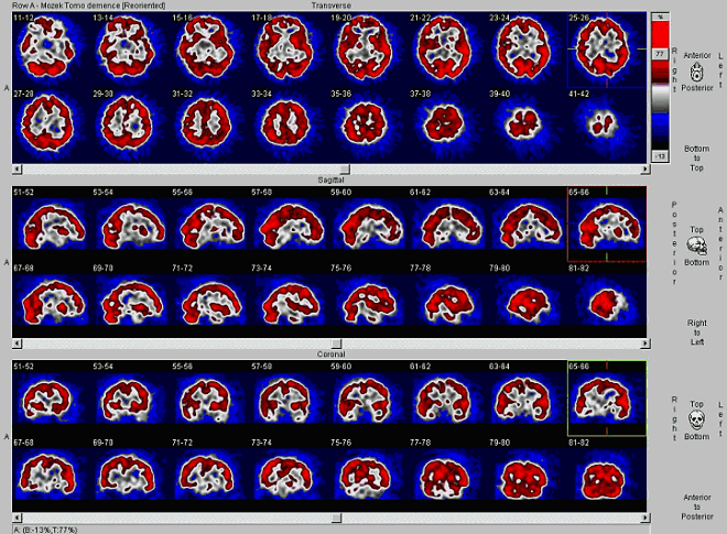 Obr. č. 1: SPECT mozku na dvouhlavé tomografické kameře. Horní dvě řady scintigramů: transaxiální řezy, prostřední dvě řady scintigramů: sagitální řezy, dolní dvě řady scintigramů: koronální řezy