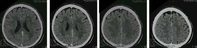 Obrázek č. 3: CT mozku po evakuaci subdurálního hematomu: (vybrané řezy) Vpravo parietálně jemnější subarachnoideální prostory ve srovnání s kontralaterální stranou, bez rozšíření subdurálního prostoru