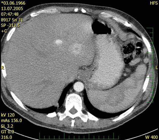 Obr. č. 1 : CT břicha – pseudocystoid v jaterním hilu