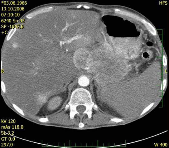 Obr. č. 2 : CT břicha – tumor těla a ocasu pankreatu