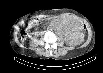 Obr. 8. CT dutiny břišní, transverzální řez