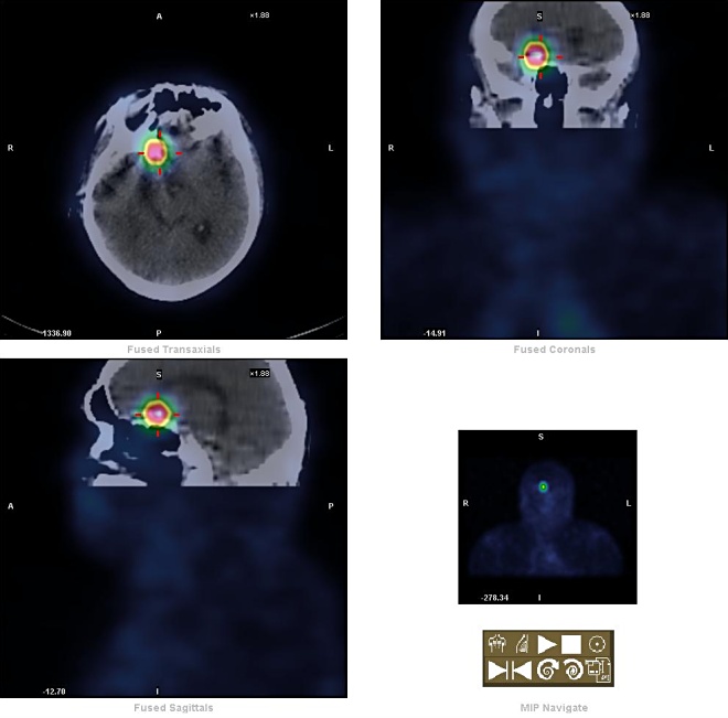 Obr. 3. fuze SPECT/CT lebky