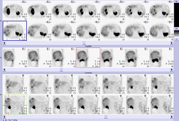 Obr. č. 3: Tomografická scintigrafie břicha a pánve 4 hod. po aplikaci OctreoScanu
