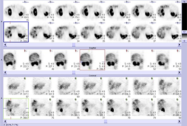 Obr. č. 4: Tomografická scintigrafie břicha a pánve 24 hod. po aplikaci OctreoScanu