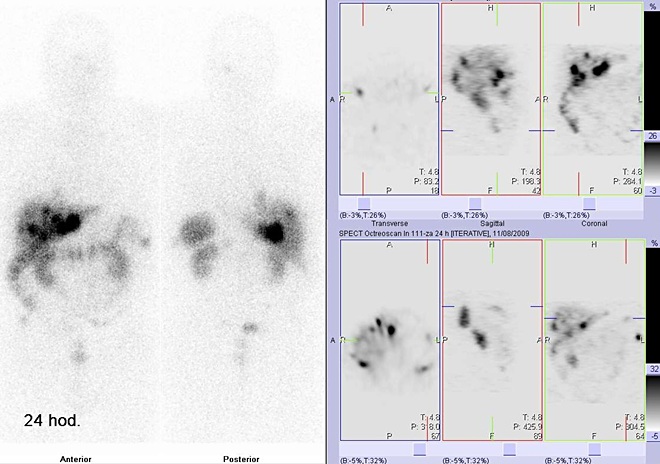 Obr..3: Celotlov scintigrafie v pedn a zadn projekci a tomografick (SPECT) scintigrafie bicha 24 hod. po aplikaci OctreoScanu