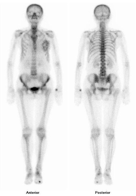 Obr. č. 1: Celotělová scintigrafie skeletu v přední a zadní projekci