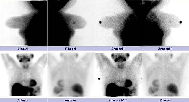 Obr. č. 1: Scintimamografie v bočních, přední a zadní projekci