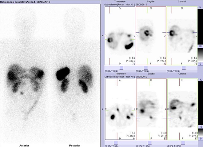 Obr. č. 6: Celotělová scintigrafie v přední a zadní projekci a tomografická scintigrafie SPECT