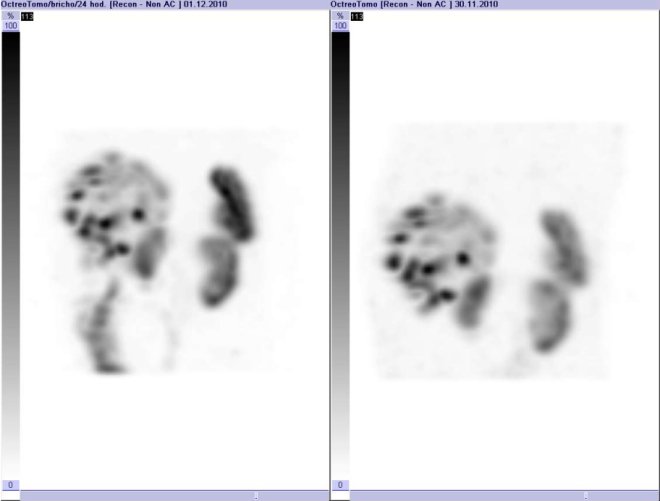 Obr. č. 5: Tomografická scintigrafie SPECT. Vyšetření 4 a 24 hod. po aplikaci radioindikátoru. Vlevo vyšetření za 24 hod., vpravo vyš. za 4 hod.