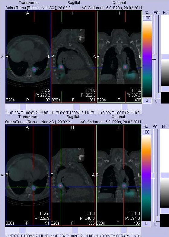 Obr. č. 2: Fúze obrazů SPECT a CT. Vyšetření 4 hod. po aplikaci radioindikátoru. Nahoře i dole vlevo transverzální řezy, uprostřed sagitální řezy, vpravo řezy koronární. Zaměřeno na ložisko v levé plíci.