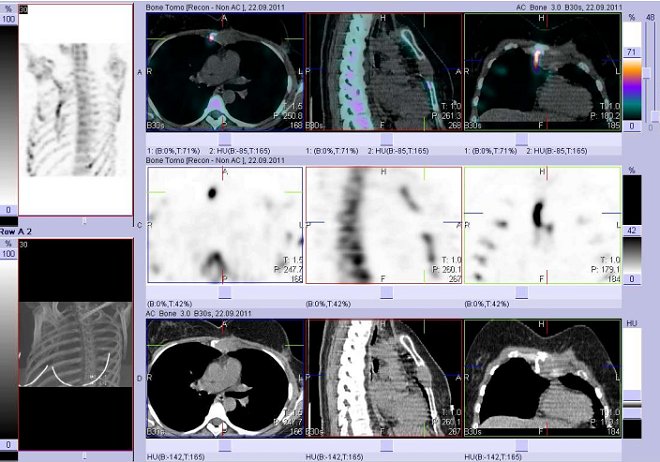 Obr. č. 3: Fúze obrazů SPECT a CT. Zaměřeno na velké osteolytické zeložisko ve sternu. Řezy transverzální, řezy sagitální a řezy koronální.