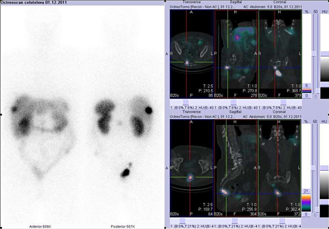 Obr. č. 2: Celotělová scintigrafie v přední a zadní projekci a fúze obrazů SPECT a CT. Vyšetření 24 hod. po aplikaci radioindikátoru. Zaměřeno na ložisko presakrálně vpravo-vpravo nahoře a na ložisko v kosti křížové-vpravo dole.
