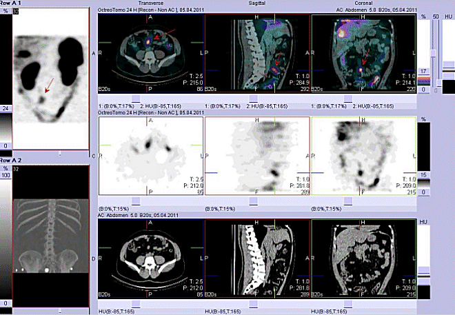 Obr. č. 4: Fúze obrazů SPECT a CT. Vyšetření 24 hod. po aplikaci radioindikátoru. Zaměřeno na ložisko v tenkém střevě vpravo od střední čáry.