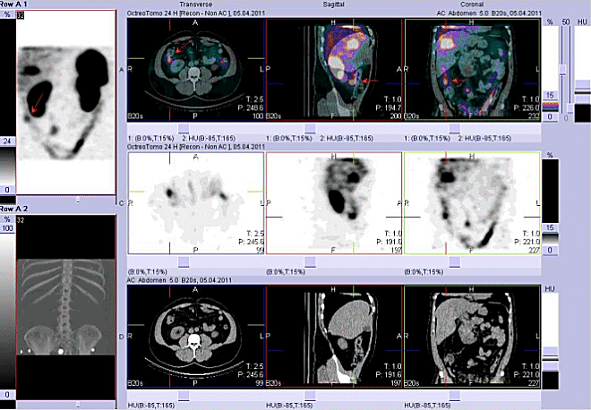Obr. č. 5: Fúze obrazů SPECT a CT. Vyšetření 24 hod. po aplikaci radioindikátoru. Zaměřeno na ložisko ve střevě vpravo laterálně.