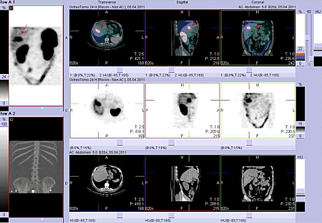 Obr. č. 6: Fúze obrazů SPECT a CT. Vyšetření 24 hod. po aplikaci radioindikátoru. Zaměřeno na velké ložisko v horní části pravého jaterního laloku.