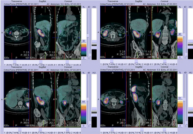 Obr. č. 4: Fúze obrazů SPECT a CT. Vyšetření 4 hod. po aplikaci radioindikátoru. Zaměřeno na různé části břicha vpravo i vlevo.