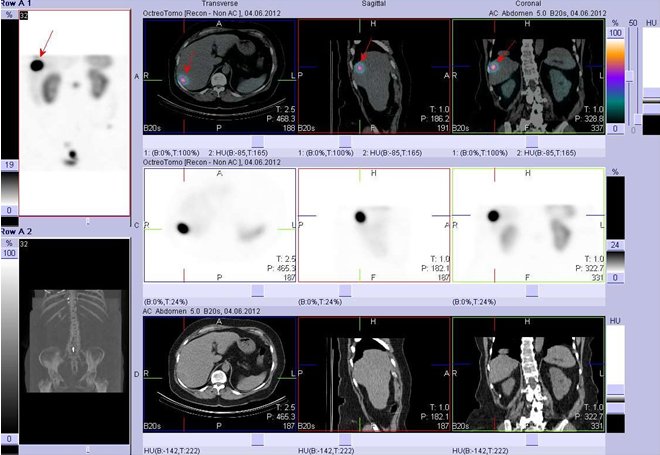 Obr.č.2: Fúze obrazů SPECT a CT. Vyšetření 5 hod. po aplikaci radioindikátoru. Zaměřeno na ložisko v pravém jaterním laloku.