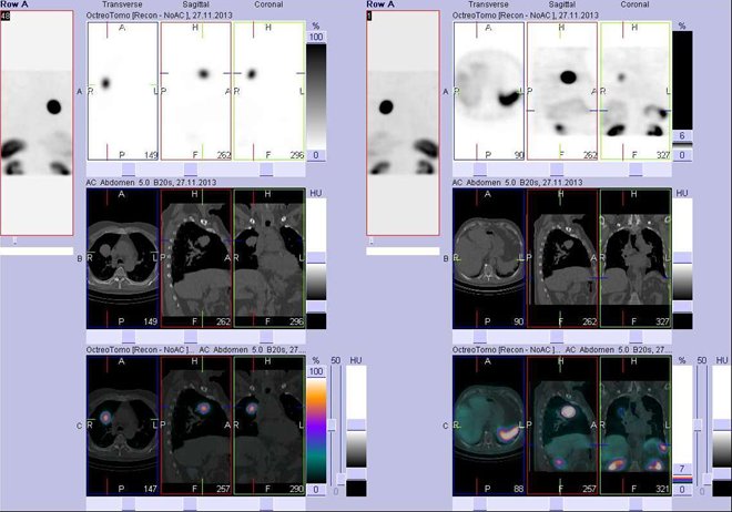 Obr. č. 2: Fúze obrazů SPECT a CT. Vyšetření 4 hod. po aplikaci radiofarmaka. Vlevo zaměřeno na ložisko v pravé plíci parahilozně, vpravo zaměřeno na játra. Vlevo i vpravo vždy nahoře SPECT, uprostřed CT, dole fúze obrazů. Vždy nad sebou: vlevo transverzální řezy, uprostřed sagitální řezy, vpravo koronární.