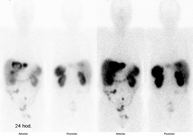 Obr. . 2: Celotlov scintigrafie v pedn a zadn projekci  2x s rznou modulac obraz. Vyeten 24 hod. po aplikaci radioindiktoru.