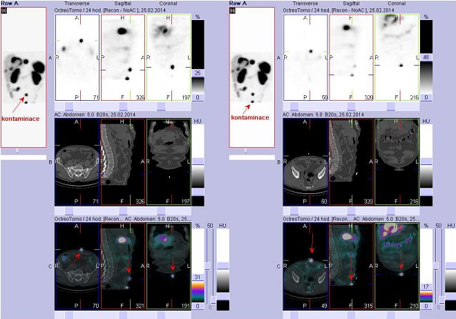 Obr. . 5: Fze obraz SPECT a CT  vyeten bicha. Vyeten 24 hod. po aplikaci radiofarmaka. Vlevo i vpravo nahoe SPECT,  uprosted CT,  dole fze obraz, zameno na dv loiska na povrchu tla v doln sti bicha ve stedn e. Jedn se o kontaminaci.