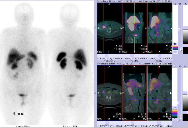 Obr. č. 3: Celotělová scintigrafie v přední a zadní projekci a fúze SPECT/CT 4 hod. po aplikaci OctreoScanu. Zaměřeno na ložiska v pravém mesogastriu.