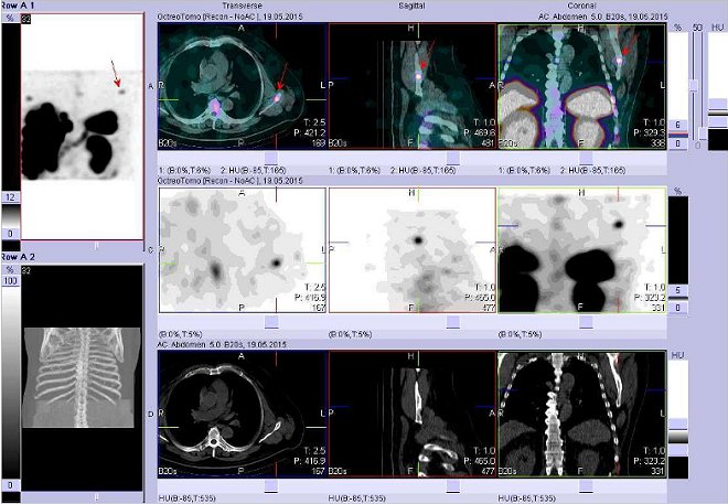 Obr. č. 11: Fúze obrazů SPECT a CT – vyšetření hrudníku a břicha. Vyšetření 24 hod. po aplikaci radiofarmaka. Nahoře fúze obrazů, uprostřed SPECT, dole CT. Vždy nad sebou: vlevo transverzální řezy, uprostřed sagitální řezy, vpravo koronární. Zaměřeno na ložisko v levé lopatce.