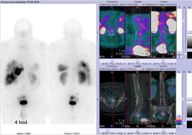 Obr.3: Celotělová scintigrafie a fúze obrazů SPECT a CT – vyšetření břicha. Vyšetření 4 hod. po aplikaci radiofarmaka. Vždy nad sebou: vlevo transverzální řezy, uprostřed sagitální řezy, vpravo koronární. Vpravo nahoře zaměřeno na ložisko v bederní páteři, vpravo dole zaměřeno na ložisko presakrálně.